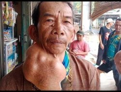 Kisah Pilu Seorang Sopir Angkot, Puluhan Tahun Bertaruh Nyawa dengan Tumor Ganas di Leher